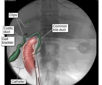 gallbladder surgery medical malpractice