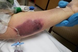 Picture showing large bruise on patient arm